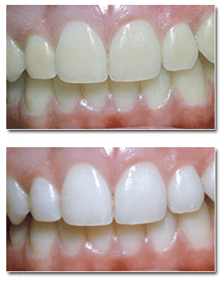 Если использоватьрекомендации стоматологов, то ваши зубы долго не потеряют свою белизну.